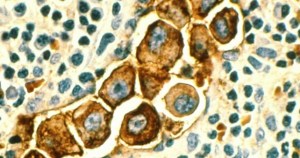 el 65% de los cánceres se debe al azar