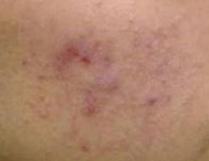 El acné en descodificación biológica