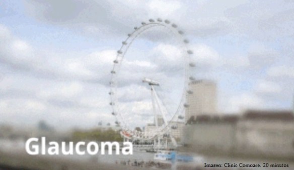 las cataratas y el glaucoma 2